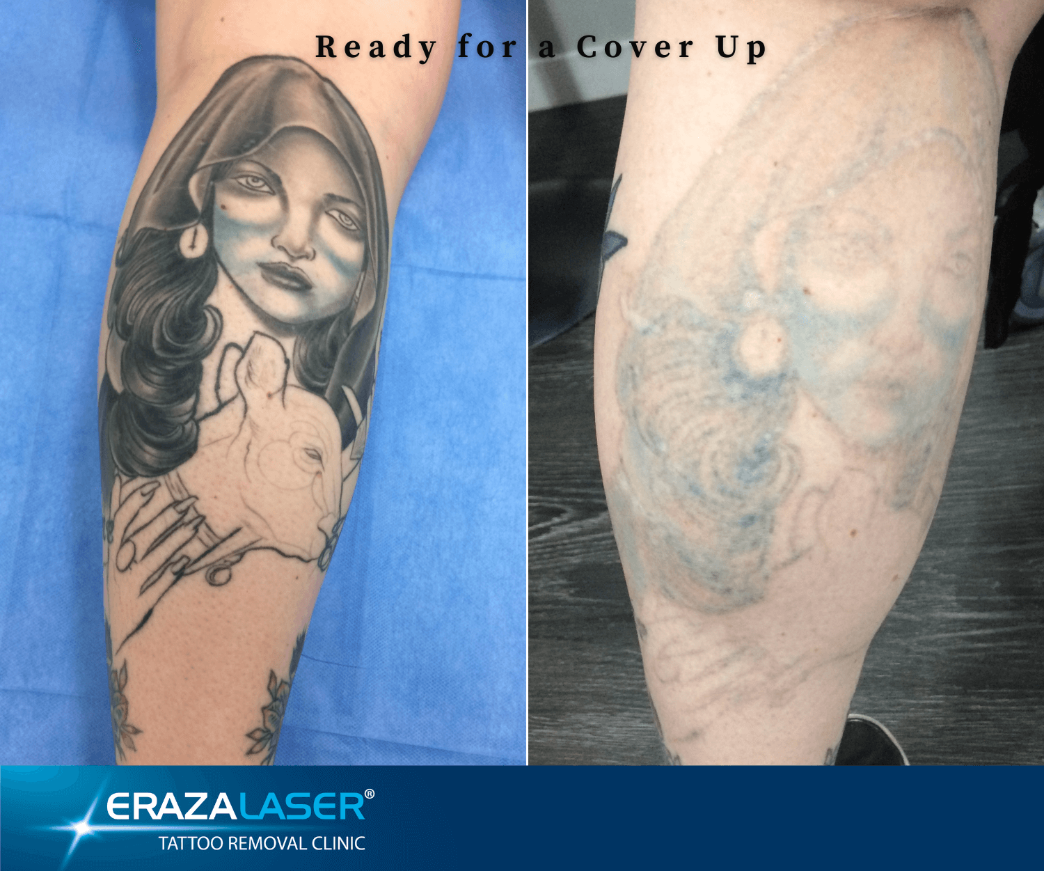 Tattoo Removal Images Before and After Photos - ERAZALASER Clinics